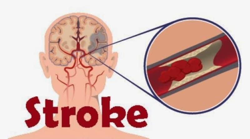 mencegah terjadinya penyakit stroke